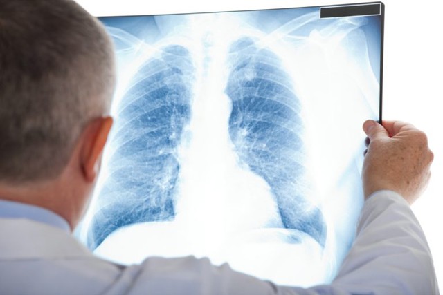 4 biểu hiện cảnh báo sớm ung thư phổi ở nam giới - Ảnh 2.