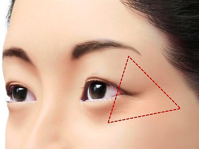 Những vết chân chim ở mắt và điều cần biết khi xóa nếp nhăn bằng Botox - Ảnh 4.