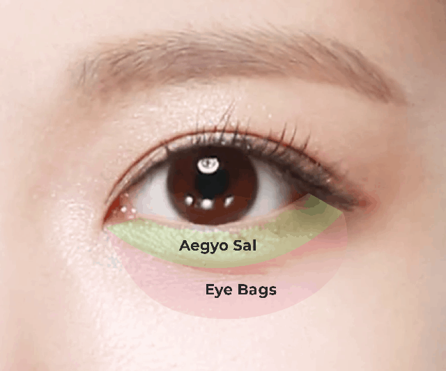 Mỡ bọng mắt dưới gây già nua khuôn mặt khác với “mắt cười” aegyo sal - Ảnh 3.