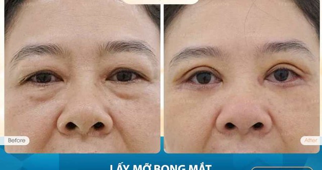 Mỡ bọng mắt dưới gây già nua khuôn mặt khác với “mắt cười” aegyo sal - Ảnh 5. Mỡ bọng mắt dưới gây già nua khuôn mặt khác với “mắt cười” aegyo sal - Ảnh 5.