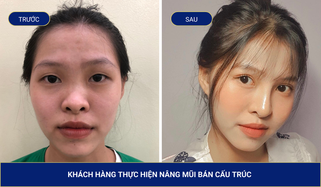 Dáng mũi nâng bán cấu trúc rất tự nhiên, hài hòa với gương mặt