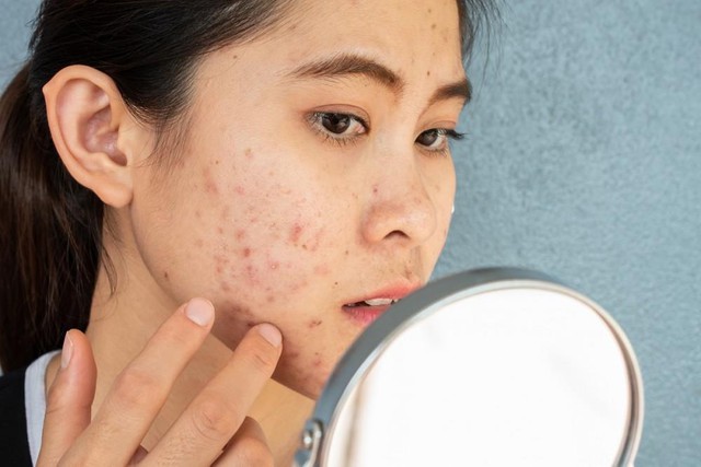 Sẹo rỗ, “vị khách không mời” bị loại bỏ từ những công nghệ mới - Ảnh 1. Sẹo rỗ, “vị khách không mời” bị loại bỏ từ những công nghệ mới - Ảnh 1.