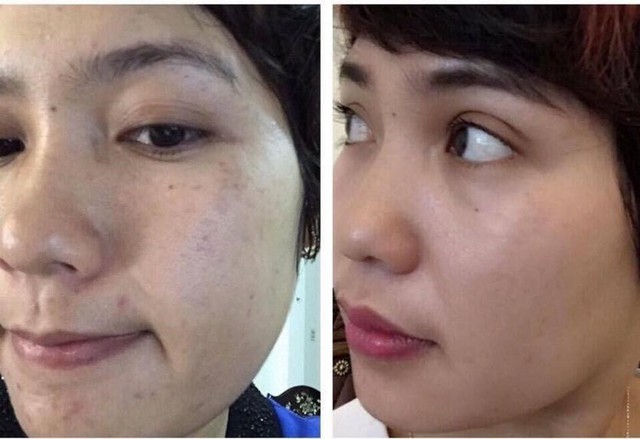 Top 5 sản phẩm chứa Hydroquinone trị nám, sáng da được chuyên gia da liễu tin dùng - Ảnh 4. Top 5 sản phẩm chứa Hydroquinone trị nám, sáng da được chuyên gia da liễu tin dùng - Ảnh 4.