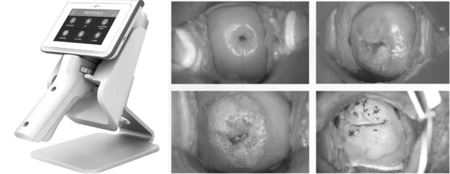 TP.HCM: Soi cổ tử cung tích hợp trí tuệ nhân tạo - Ảnh 1.