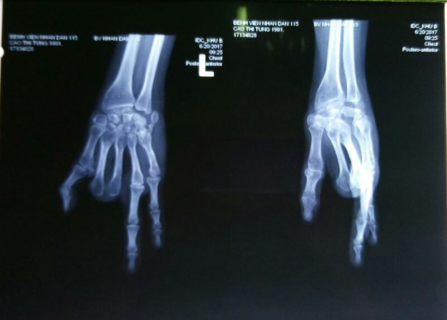 Bệnh nhân mất 4 ngón tay được ghép thành công 1 ngón - Ảnh 3.