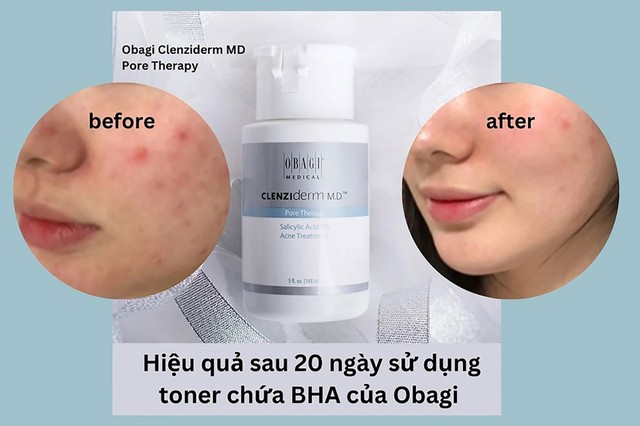 Top 8 tẩy tế bào chết cho da dầu mụn sạch mịn, tươi sáng được yêu chuộng - Ảnh 6. Top 8 tẩy tế bào chết cho da dầu mụn sạch mịn, tươi sáng được yêu chuộng - Ảnh 6.