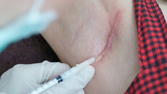 Lasre thế hệ mới, “khắc tinh” của những vết sẹo lồi đáng ghét - Ảnh 3. Lasre thế hệ mới, “khắc tinh” của những vết sẹo lồi đáng ghét - Ảnh 3.