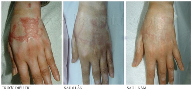 Lasre thế hệ mới, “khắc tinh” của những vết sẹo lồi đáng ghét - Ảnh 5. Lasre thế hệ mới, “khắc tinh” của những vết sẹo lồi đáng ghét - Ảnh 5.