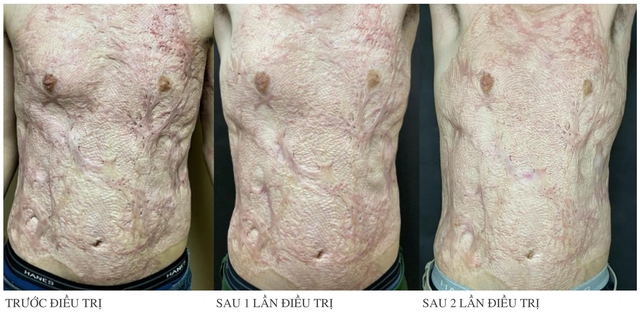 Lasre thế hệ mới, “khắc tinh” của những vết sẹo lồi đáng ghét - Ảnh 6. Lasre thế hệ mới, “khắc tinh” của những vết sẹo lồi đáng ghét - Ảnh 6.