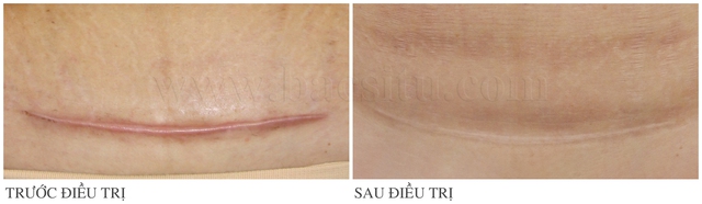 Lasre thế hệ mới, “khắc tinh” của những vết sẹo lồi đáng ghét - Ảnh 7. Lasre thế hệ mới, “khắc tinh” của những vết sẹo lồi đáng ghét - Ảnh 7.