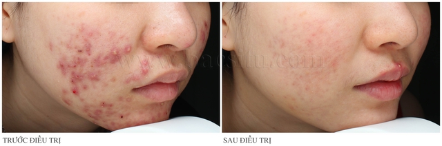 Lasre thế hệ mới, “khắc tinh” của những vết sẹo lồi đáng ghét - Ảnh 9. Lasre thế hệ mới, “khắc tinh” của những vết sẹo lồi đáng ghét - Ảnh 9.
