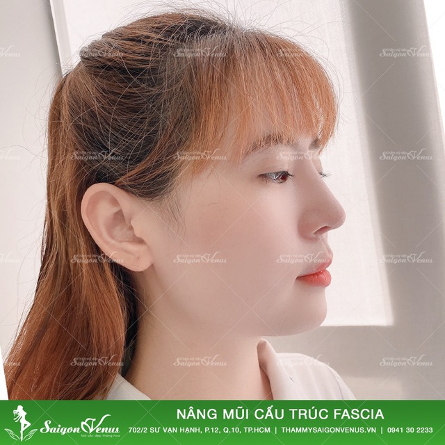 Nâng mũi cấu trúc Sụn sườn Fascia bao lâu hết sưng ? - Ảnh 3.