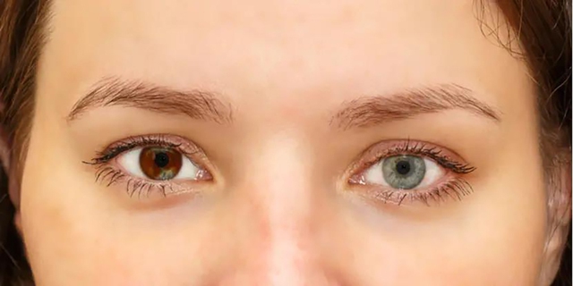 Những bệnh lý nào làm thay đổi mống mắt?- Ảnh 1.
