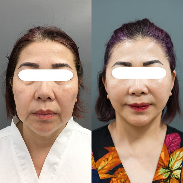 Xu hướng trẻ hóa hàng đầu căng da nội soi kết hợp cấy mỡ tự thân - Ảnh 1. Xu hướng trẻ hóa hàng đầu căng da nội soi kết hợp cấy mỡ tự thân - Ảnh 1.