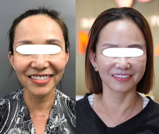 Xu hướng trẻ hóa hàng đầu căng da nội soi kết hợp cấy mỡ tự thân - Ảnh 2. Xu hướng trẻ hóa hàng đầu căng da nội soi kết hợp cấy mỡ tự thân - Ảnh 2.