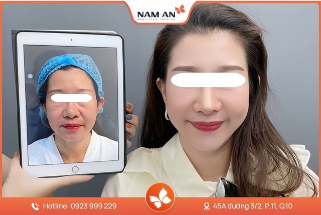 Xu hướng trẻ hóa hàng đầu căng da nội soi kết hợp cấy mỡ tự thân - Ảnh 4. Xu hướng trẻ hóa hàng đầu căng da nội soi kết hợp cấy mỡ tự thân - Ảnh 4.