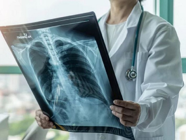 Khi phân tích ảnh chụp X-quang phổi, AI có thể sàng lọc ung thư phổi tốt hơn gấp đôi so với bác sĩ