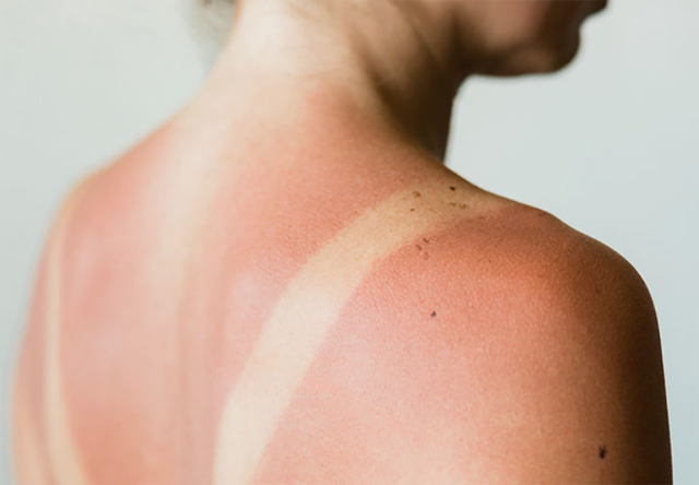 Hiện tượng cháy nắng do da tiếp xúc với ánh nắng mặt trời