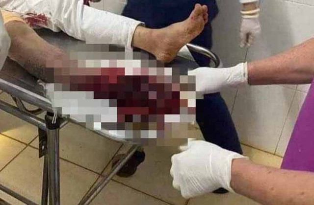 Đắk Lắk: Nam thanh niên bị ô tô tông nát bàn chân nghi do trả thù nhầm - Ảnh 2.