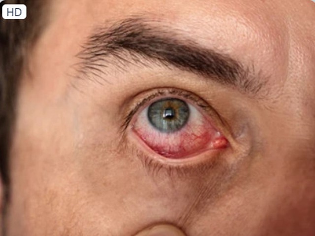 Chàng trai bị nhiễm trùng ăn vào mắt gây mù chỉ vì làm điều này  - Ảnh 1.