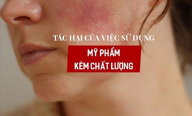 Nhiều hậu quả khôn lường khi dùng mỹ phẩm không đảm bảo chất lượng