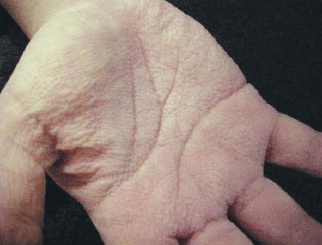 Nếu tay có dấu hiệu này, 95% khả năng là ung thư  - Ảnh 2.