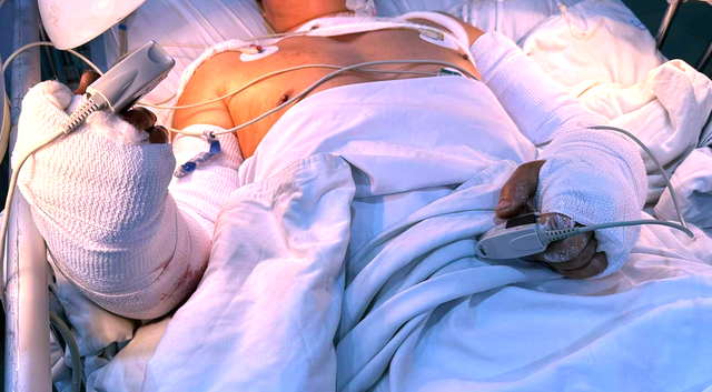 Bệnh viện Chấn thương chỉnh hình cứu bệnh nhân bị máy cắt lìa 2 cẳng tay - Ảnh 2.