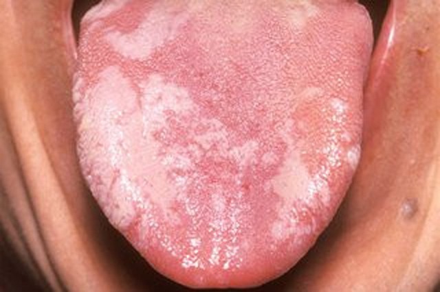 Dấu hiệu trong miệng nếu kéo dài hơn 2 tuần có khả năng trở thành ung thư - Ảnh 2.