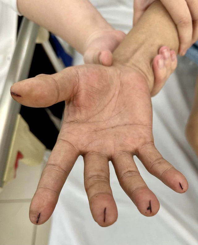 Vợ dùng dao lam cắt 5 đầu ngón tay chồng để cấp cứu đột quỵ - Ảnh 1.