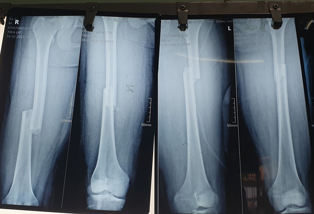 Đồng Nai: Lần đầu phẫu thuật nối xương đùi cả 2 chân cho bệnh nhi bị đa chấn thương - Ảnh 1.