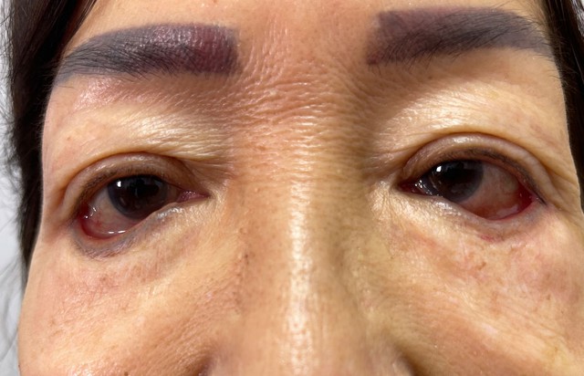 Mắt đỏ, mi mắt lật ngược suốt 40 năm do tiêm silicon - Ảnh 1.
