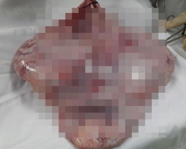 Sóc Trăng: Phẫu thuật cắt khối u 8,5 kg ra khỏi người thiếu nữ 19 tuổi - Ảnh 2.