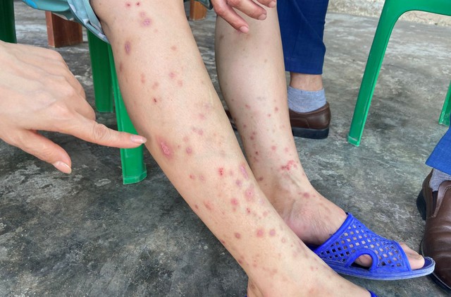 Hà Tĩnh: Côn trùng lạ cắn đốt khiến 126 người dân bị viêm da là bọ chét - Ảnh 1.