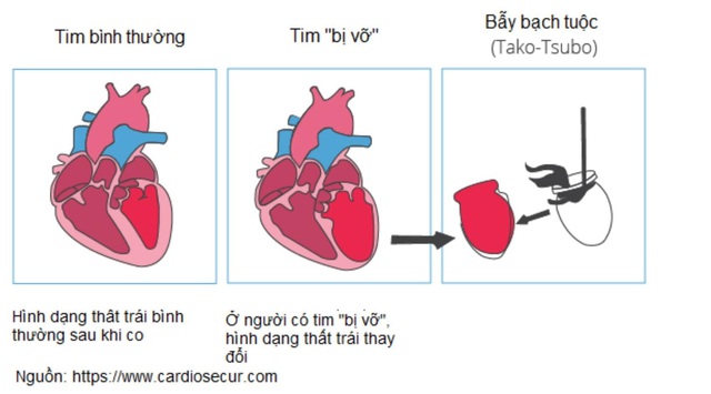 Cứu người phụ nữ suýt chết vì 'hội chứng trái tim tan vỡ'  - Ảnh 1.