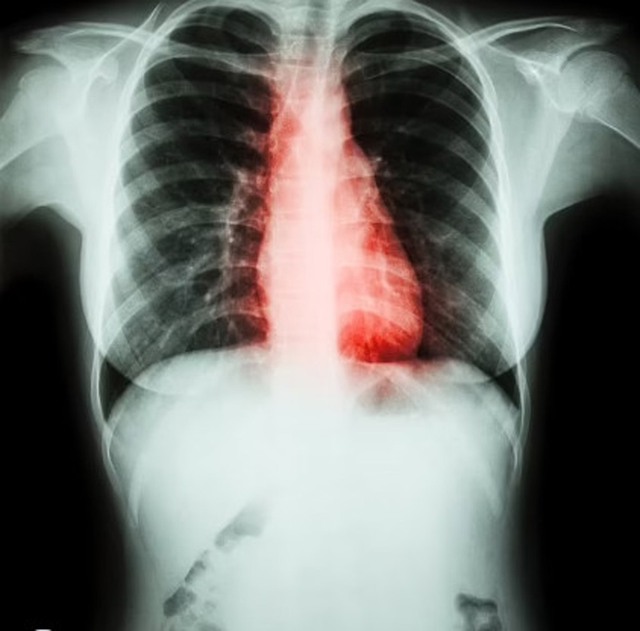 Ung thư phổi, nếu gặp dấu hiệu này ở chân, thường sống được 5 tháng - Ảnh 1.