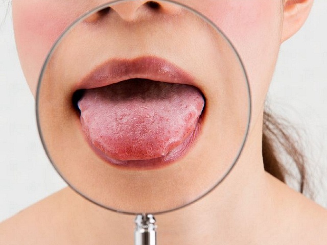 4 dấu hiệu thiếu vitamin D làm xuất hiện bất thường trên lưỡi - Ảnh 1.