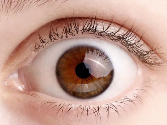 Người bị cao huyết áp cần phòng tránh những bệnh mắt nào ? - Ảnh 1.