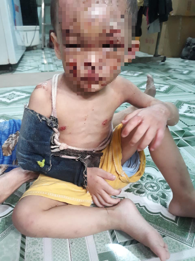 Vụ bé trai 2 tuổi bị bạo hành: 'Thương vô cùng khi thấy cháu đau đớn!'   - Ảnh 1.