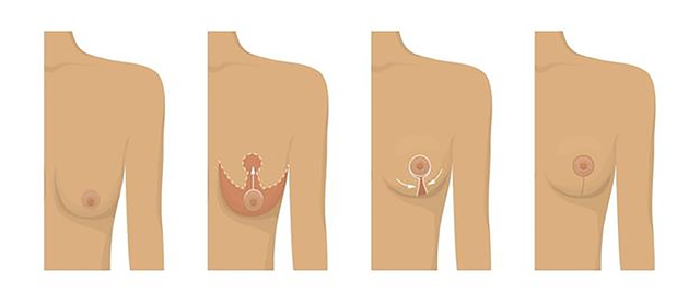 Treo ngực sa trễ là phương pháp phẫu thuật loại bỏ phần da và mỡ thừa, kéo căng các mô và cơ ở ngực lên cao