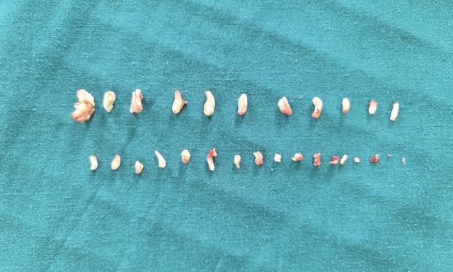 Phát hiện 28 chiếc răng lớn nhỏ trong khối u bệnh nhi 9 tuổi ở Quảng Bình - Ảnh 1.