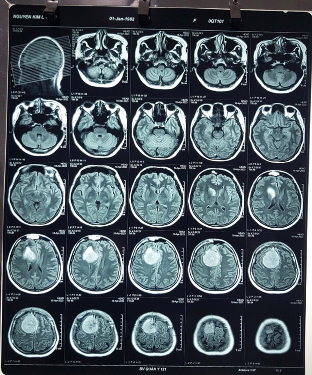 Nhập viện do tai nạn giao thông, phát hiện có khối u to trong não - Ảnh 2.