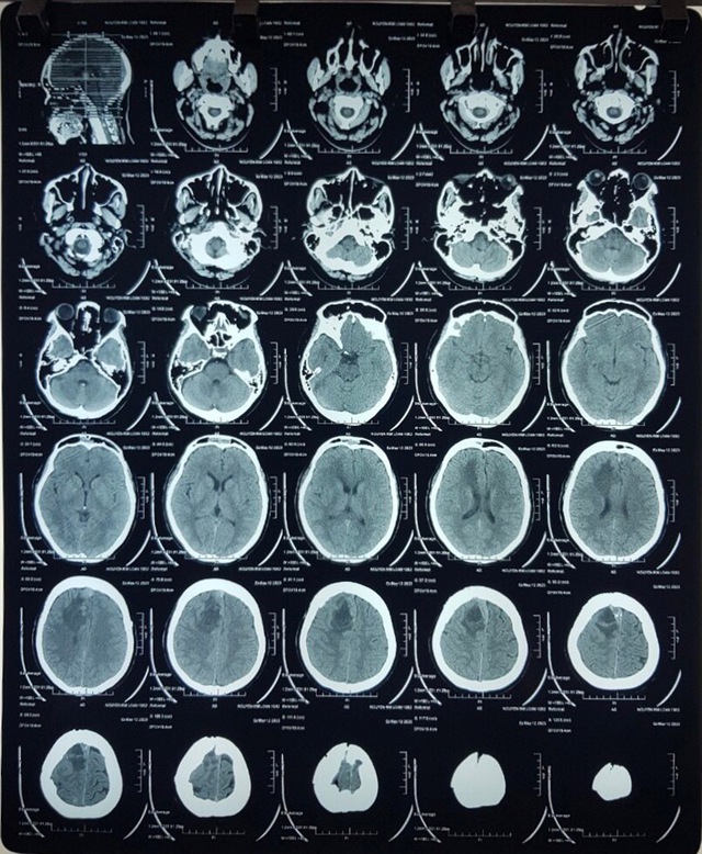 Nhập viện do tai nạn giao thông, phát hiện có khối u to trong não - Ảnh 3.