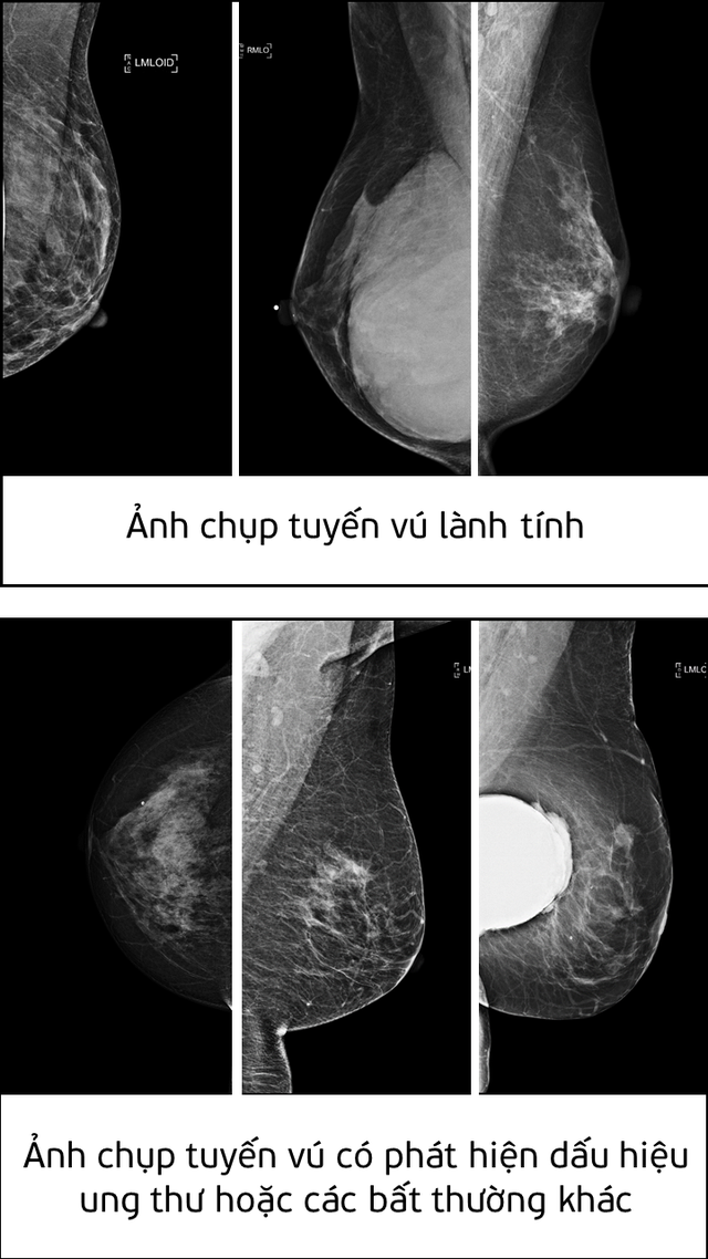 Chuyên gia AI Viettel giành giải nhất giải pháp phát hiện ung thư tuyến vú - Ảnh 1.