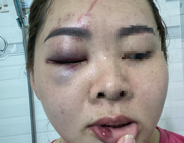Đắk Lắk: Cô giáo mầm non bị chồng đánh nhập viện - Ảnh 1.