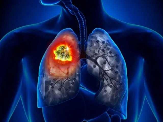 4 yếu tố gây ung thư phổi với người không hút thuốc - Ảnh 1.