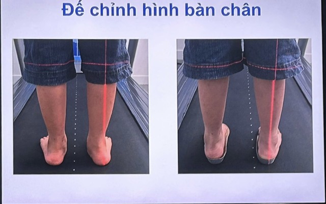 Tầm soát bàn chân bẹt và chứng cong vẹo cột sống miễn phí cho học sinh  - Ảnh 1.