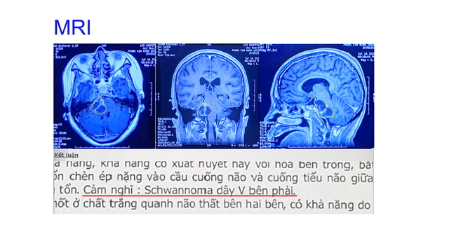 Cứu bệnh nhân u não 'tiên lượng xấu' bằng robot mổ não hiện đại Modus V Synaptive- Ảnh 1.