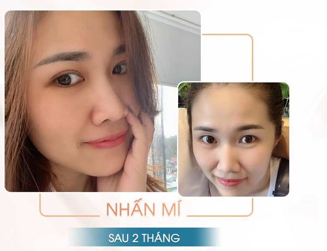 Sự khác biệt giữa nhấn mí, cắt mí cho đôi mắt không phải ai cũng biết    - Ảnh 2.