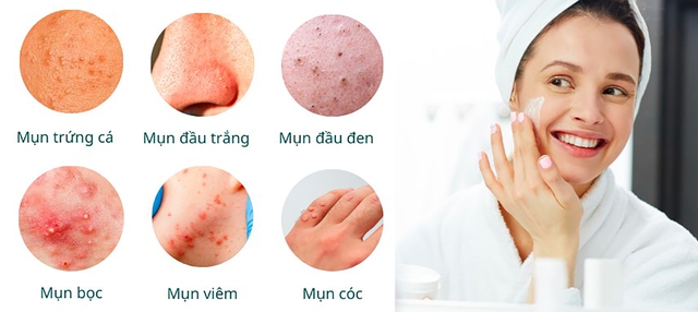 Mụn và cách phân biệt mụn chuẩn xác 100% ai cũng cần biết