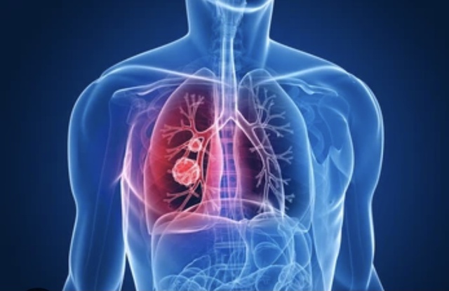 Bằng chứng khoa học chỉ ra cách tốt nhất để tránh ung thư phổi, ruột và vú   - Ảnh 1.
